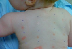 Cómo detectar las primeras alergias en el bebé